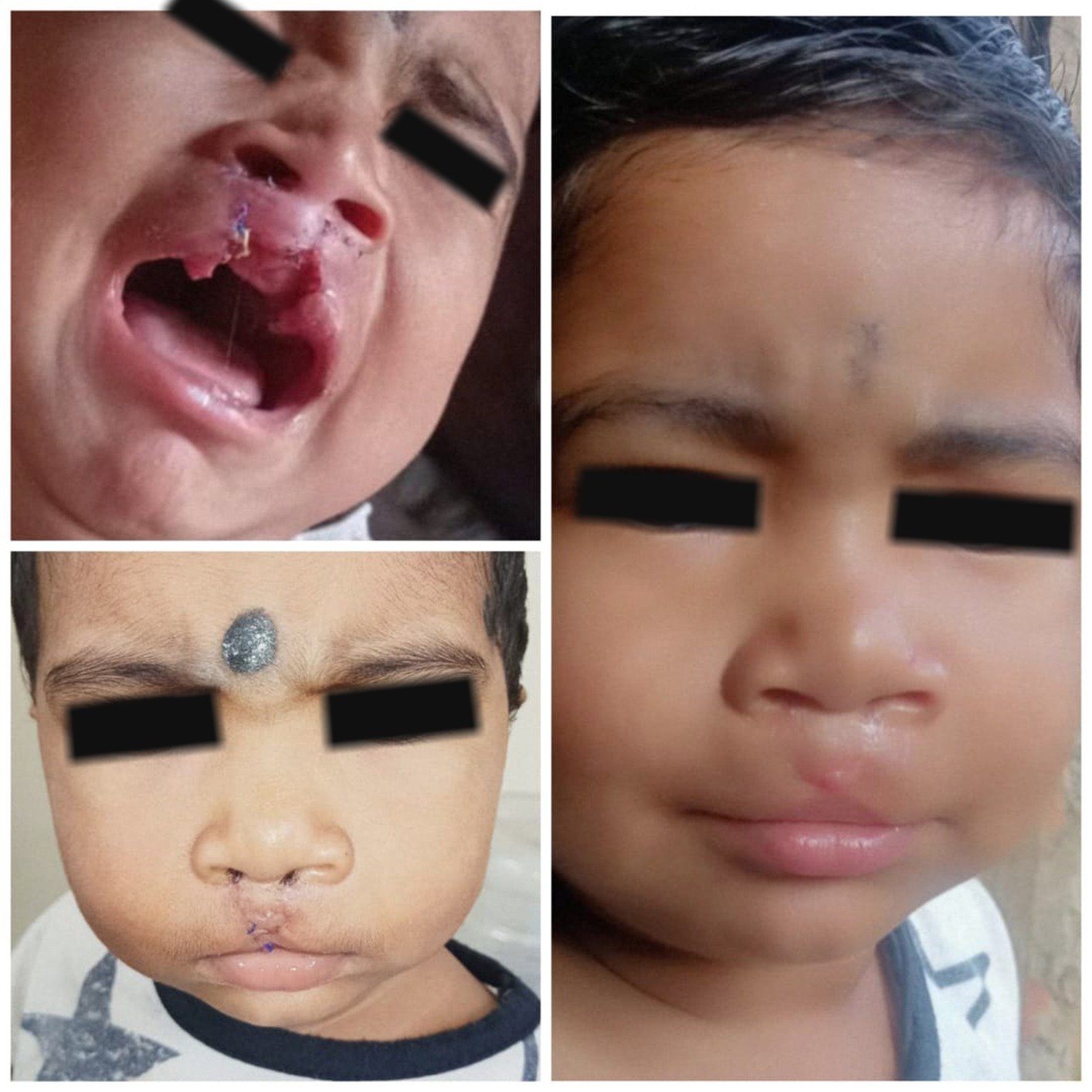 Secondary lip repair